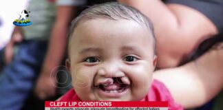 Health experts advocate adequate breastfeeding for Cleft Lip babies