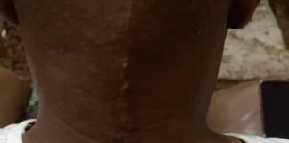 Happening now….Former ekiti state governor Ayo Fayose, undergoes surgery abroad.